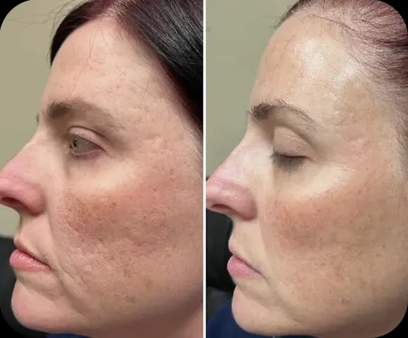 Revitalise Your Skin: Expert Microdermabrasion Near Oakville
