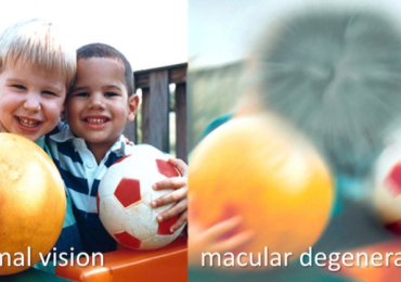Dry macular degeneration San Diego | Retina Center of San Diego