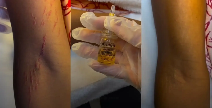 Discover Vitiligo Skin Camouflage Treatment in Dubai