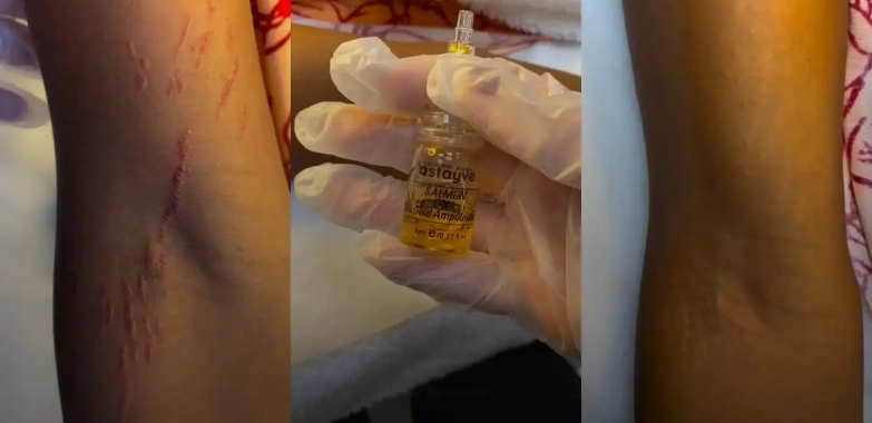 Discover Vitiligo Skin Camouflage Treatment in Dubai