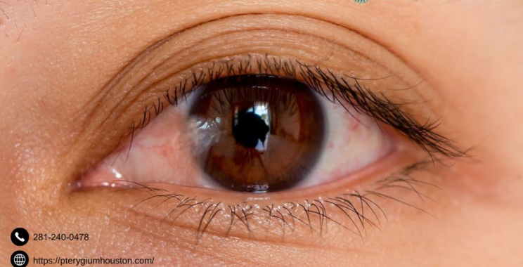 Pterygium Remedy | Pterygiumhouston.com