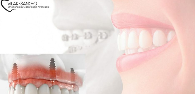 Guía de costos de ortodoncia en Pozuelo: opciones y cuidados
