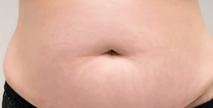 Achieve Smooth Skin: Expert Camouflage for Stretched Marks in Dubai