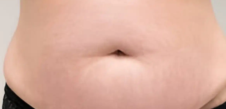 Achieve Smooth Skin: Expert Camouflage for Stretched Marks in Dubai