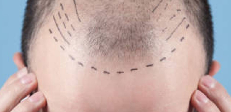 Revitalise Your Hair: Expert Treatments for Hinjewadi Residents