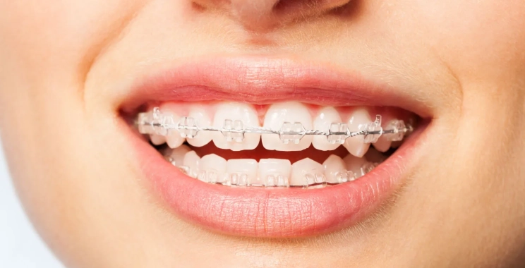 Understanding the Price of Orthodontic Treatments in the UK