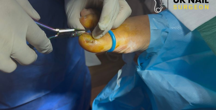 Relief for painful toenails: expert care and quick recovery