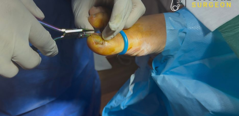 Relief for painful toenails: expert care and quick recovery