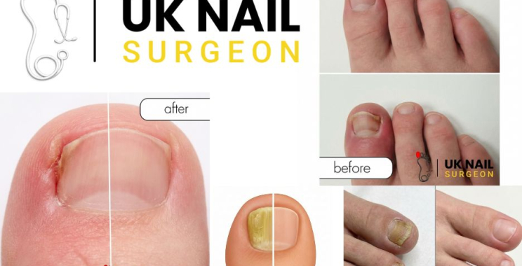Clear Path to Healthier Nails with Expert Foot Surgery