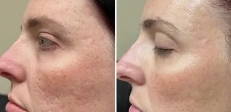 Revitalise Your Skin: Expert Microdermabrasion Near Oakville