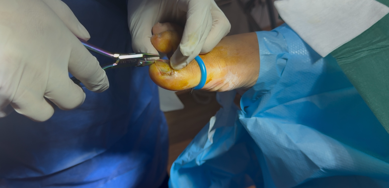 Effective Fungal Nail Treatment in Birmingham – Quick, Trusted Care