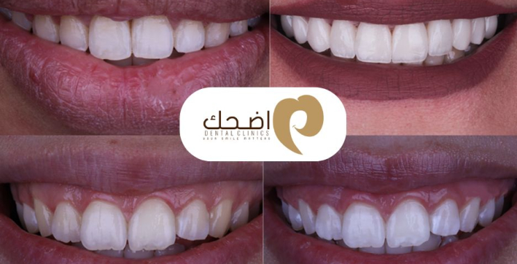 طرق فعالة لتخفيف ألم الأسنان وعلاج الأسباب الشائعة