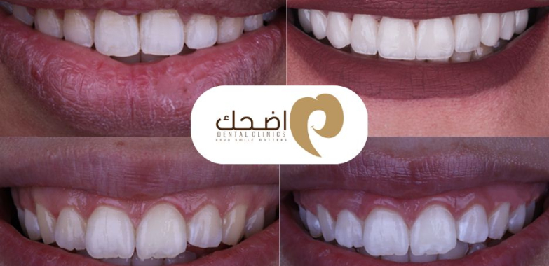 طرق فعالة لتخفيف ألم الأسنان وعلاج الأسباب الشائعة