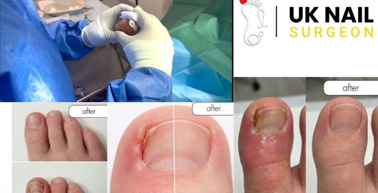 Relieving Ingrown Toenails: Expert Care and Quick Recovery