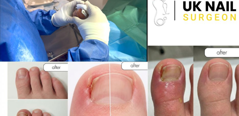 Relieving Ingrown Toenails: Expert Care and Quick Recovery