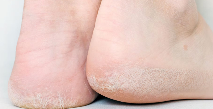 How to Beat Foot Fungus: Practical, Safe Treatment Tips