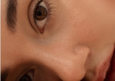 Skin Boosters Kingswinford – Pure Skin Aesthetics