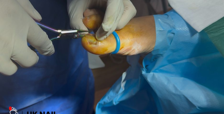 Restore Healthy Nails: Effective Solutions for Fungal Infections