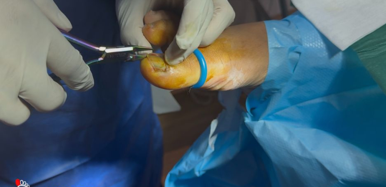Restore Healthy Nails: Effective Solutions for Fungal Infections